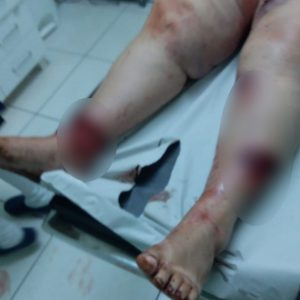 Mulher é ferida após ser  atacada por Pitbull em Novo Machado